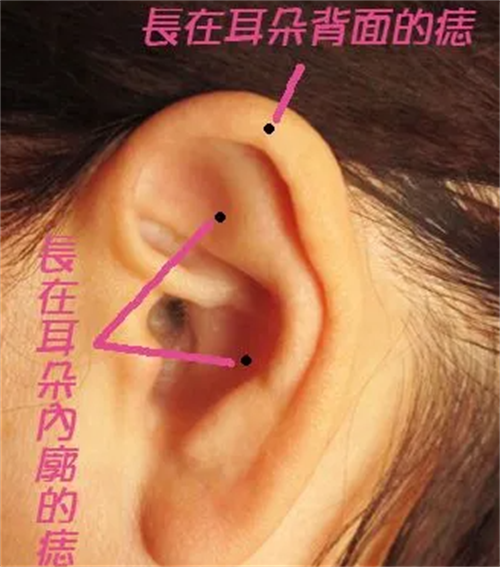 耳屏耳朵里有痣代表什么